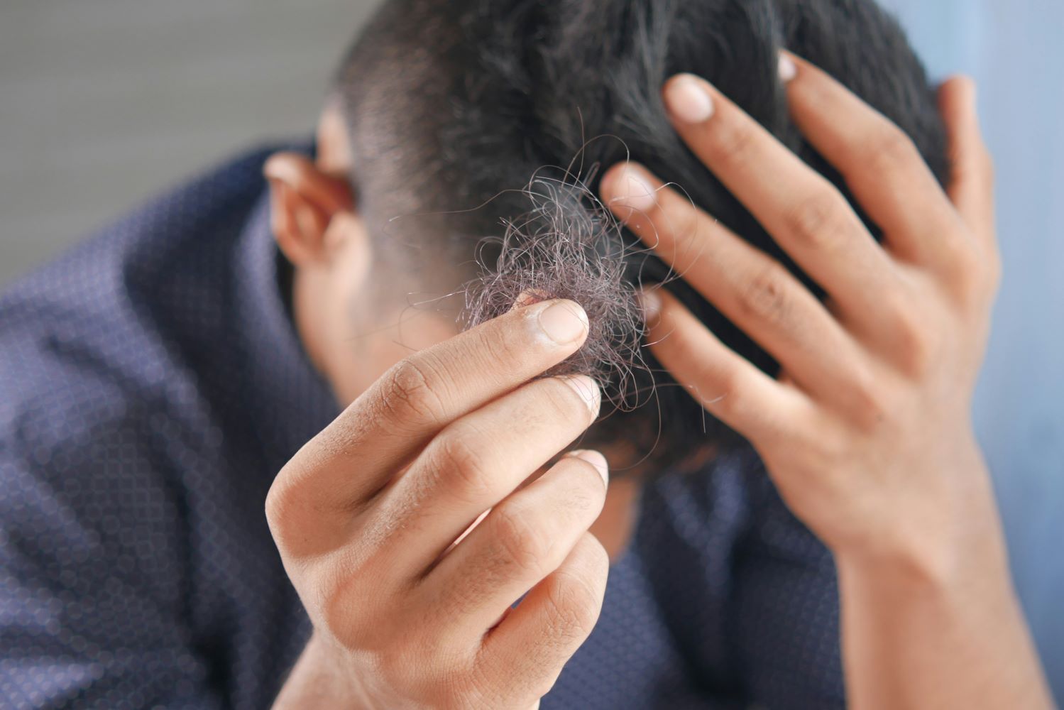 Why am I still going bald on Finasteride?