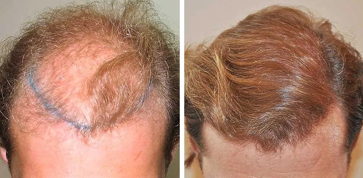 hair transplant performed at the Wimpole Clinic