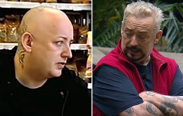 Boy George hair transplant