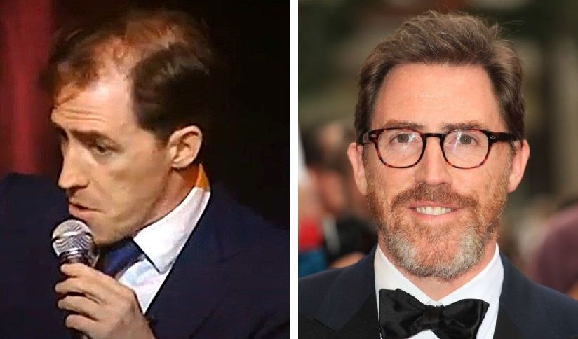 Rob Brydon before and after hair restoration