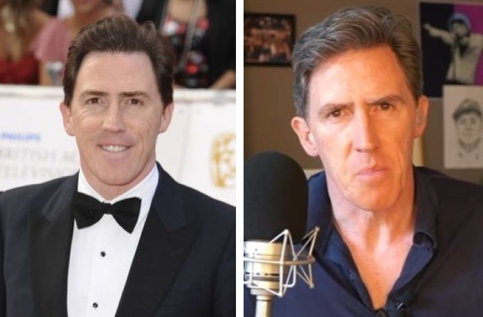 Rob Brydon post hair transplant