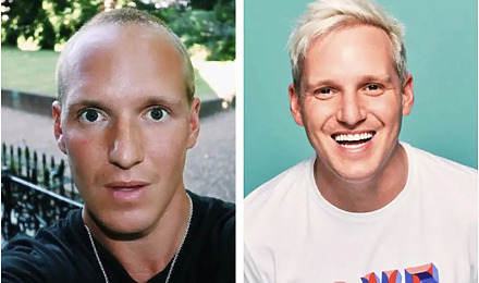 Jamie Laing Hair Transplant Before And After