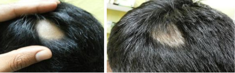 Alopecia areata before and after Minoxidil treatment