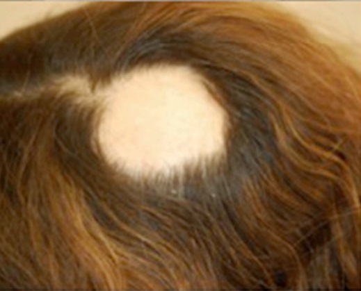 Alopecia areata symptoms