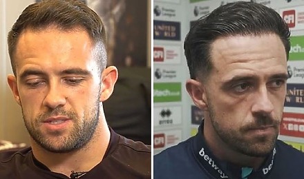 Danny Ings Hair Transplant