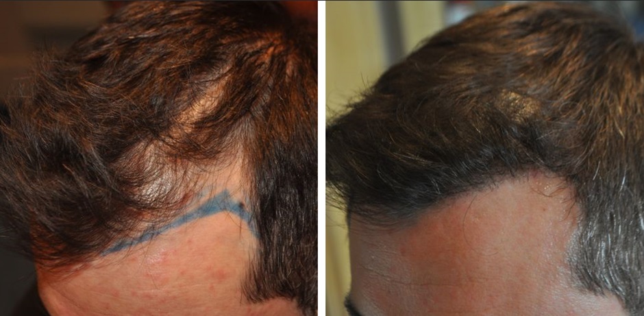 Hair transplant performed at the Wimpole Clinic