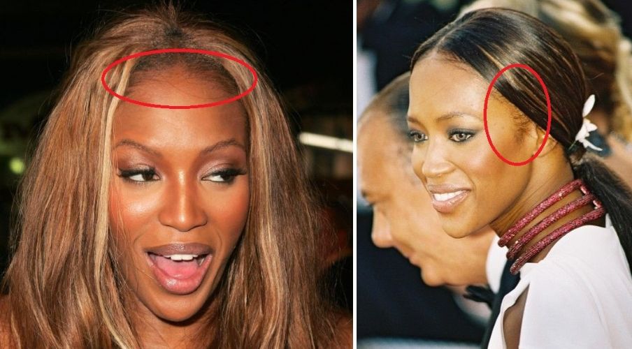 Naomi Campbell traction alopecia symptoms