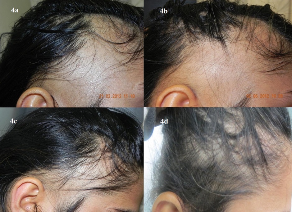 Ophiasis alopecia before and after steroid treatment