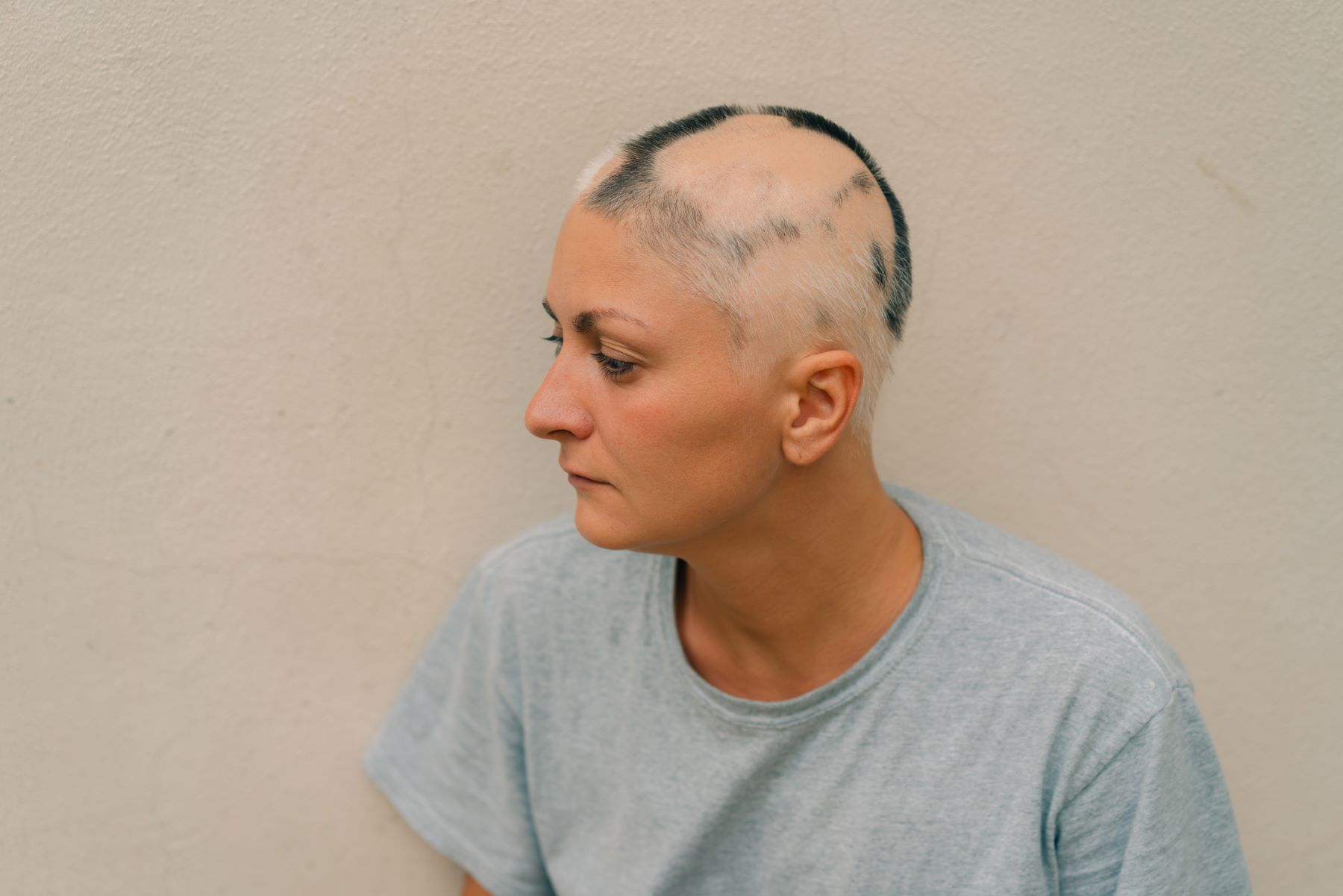 Patient whose alopecia areata is spreading