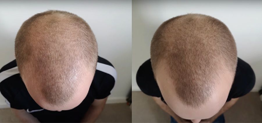 scalp massage hair growth before and after