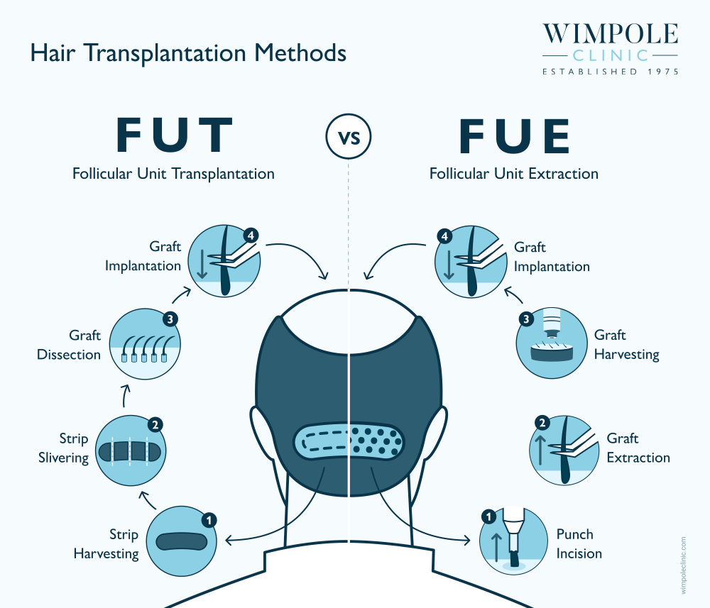 Hair Transplantation Methods