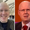 Matt Lucas Alopecia: Everything You Need To Know