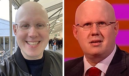 Matt Lucas Alopecia