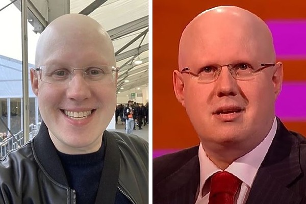 Matt Lucas Alopecia