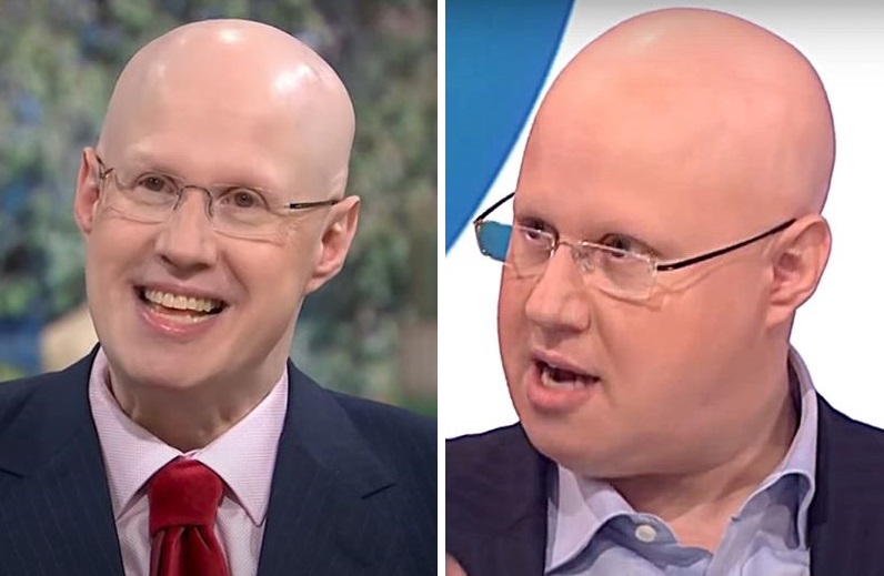 Matt Lucas bald