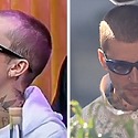 Justin Bieber Hair Loss: Everything You Need To Know