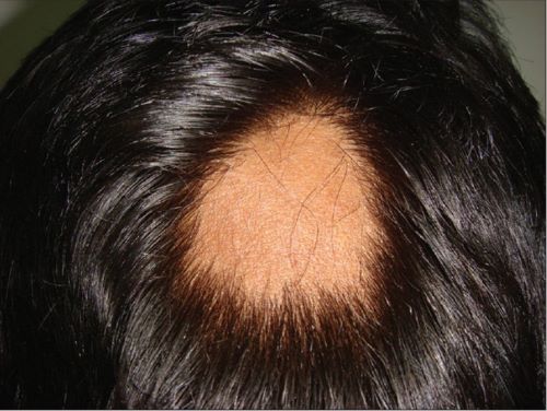 Man with alopecia areata