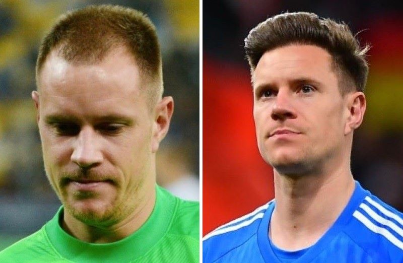 Marc Andre Ter Stegen Hair Transplant