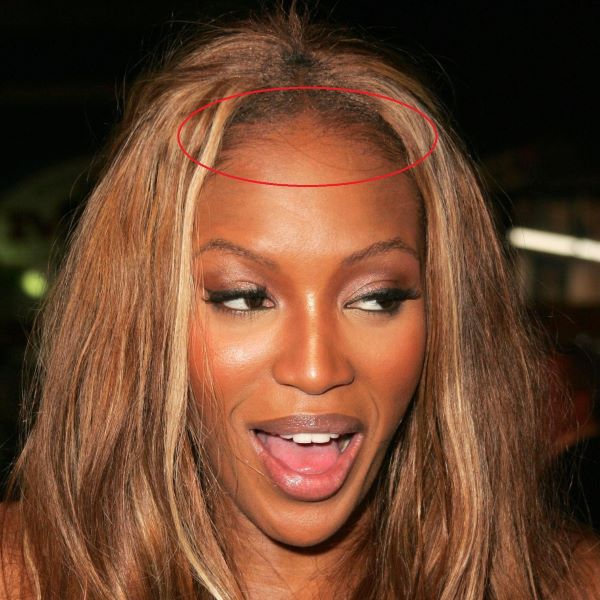 Naomi Campbell traction alopecia