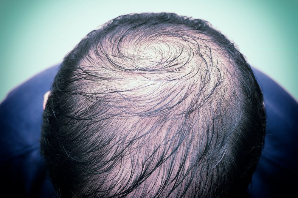 Man with scalp visible through hair
