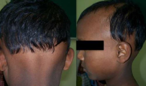 Child ophiasis alopecia