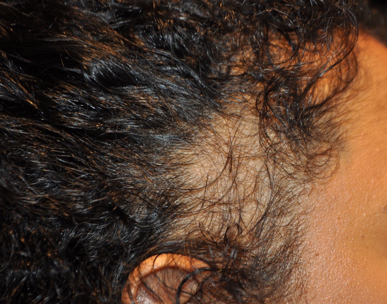 Example of traction alopecia at the side temple