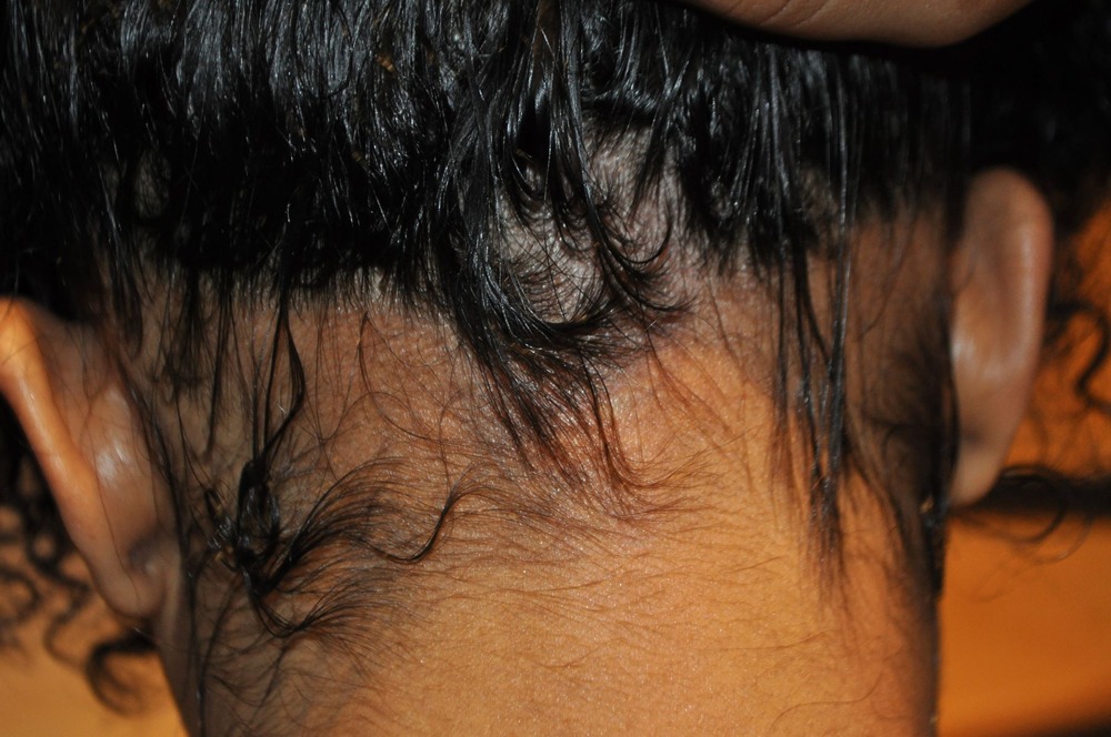 Example of traction alopecia