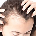 Female Temple Hair Loss: Causes, Prevention, Treatment