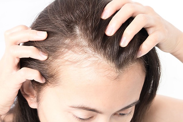 female hair loss at temples