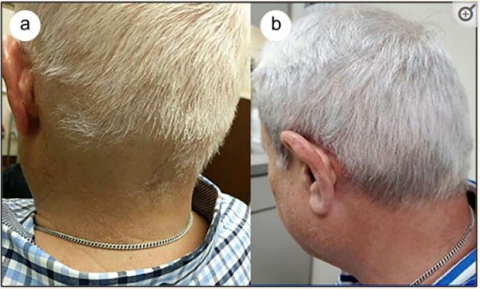 Hair growth in ophiasis alopecia after treatment