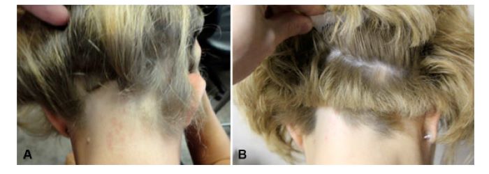 Hair regrowth in ophiasis alopecia after PRP treatment