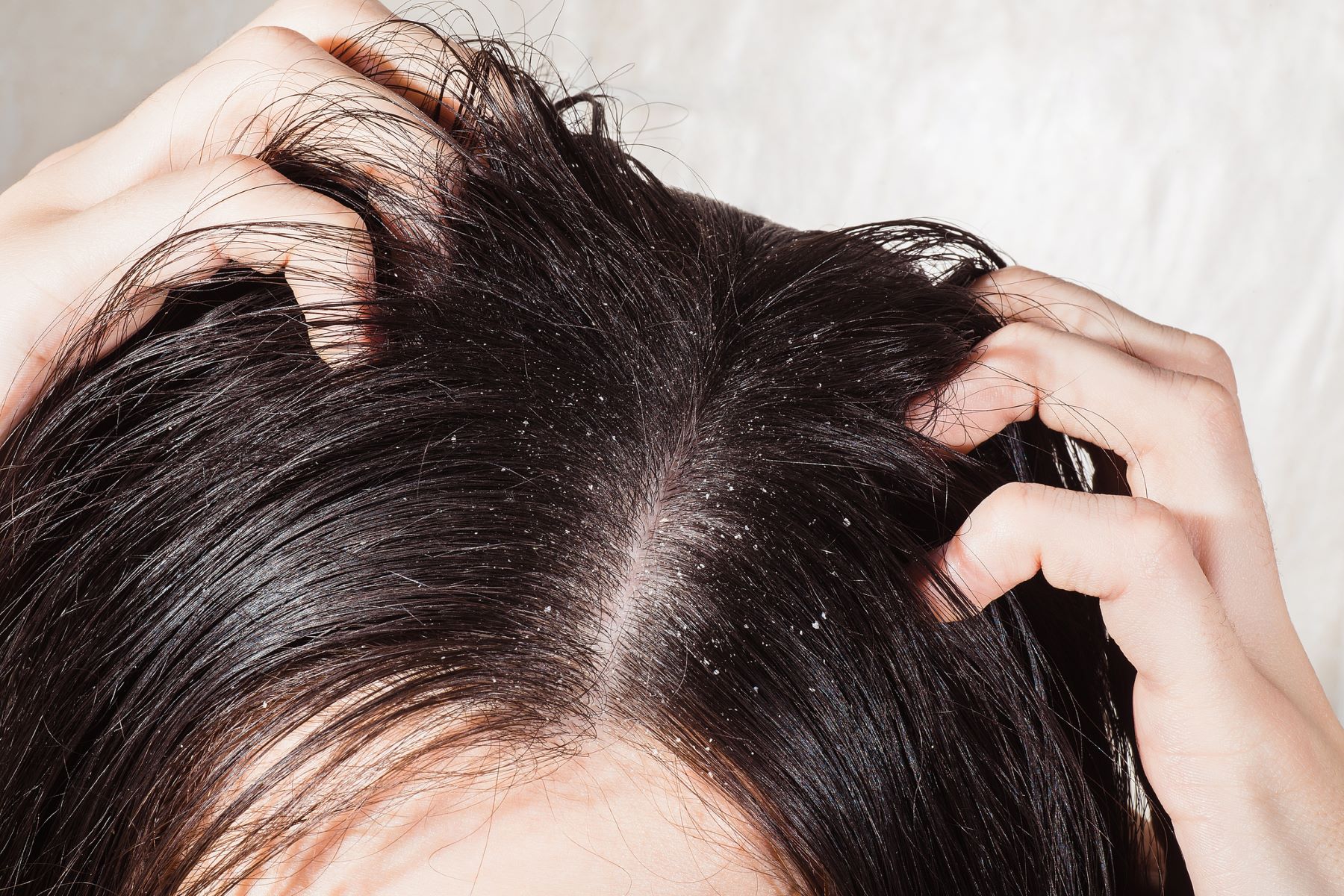 Itchy, dry scalp