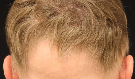 Ophiasis Alopecia: Causes, Symptoms And Treatments