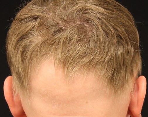 Ophiasis Alopecia: Causes, Symptoms And Treatments