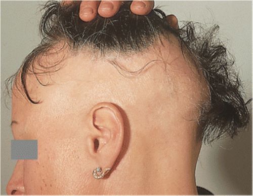 Patient with ophiasis alopecia