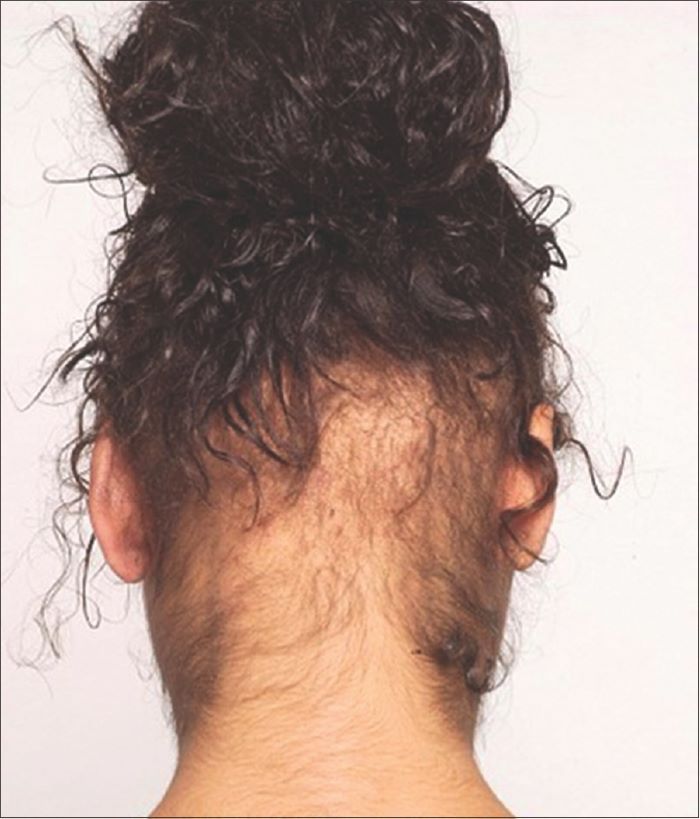 Traction alopecia on the back of the head