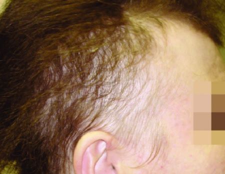 Woman with diffuse alopecia areata