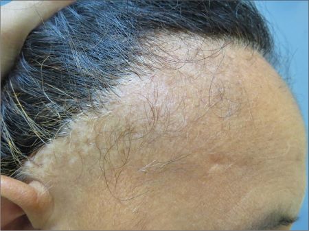 Woman with frontal fibrosing alopecia