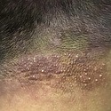 Scalp Folliculitis According To The NHS: Causes & Treatments