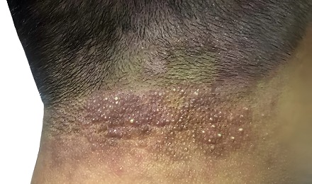 Scalp Folliculitis Nhs