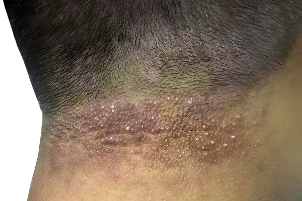 scalp folliculitis nhs