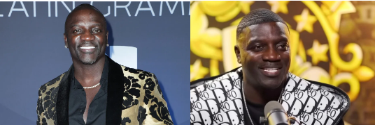 Akon before and after hair transplant
