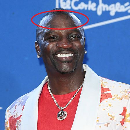 Akon's receding hairline