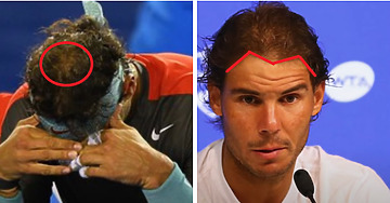 Rafael Nadal Hair Transplant: Everything You Need To Know