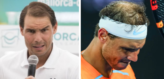 Rafael Nadal Hair Transplant: Everything You Need To Know, Wimpole Clinic
