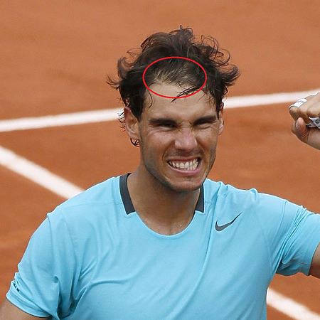 Nadal's m-shaped hairline
