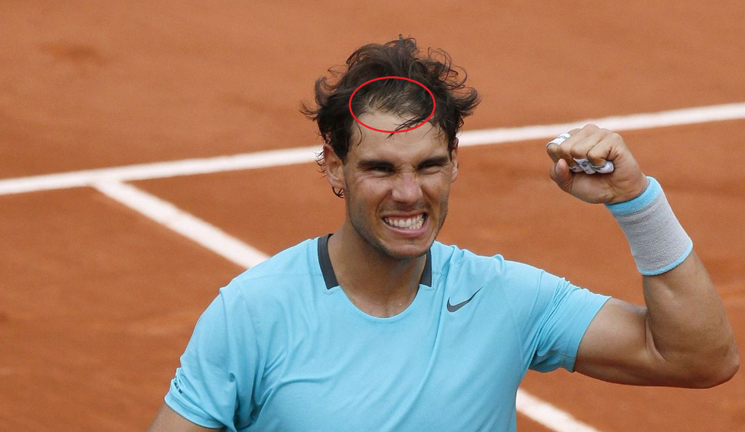 Nadal's m-shaped hairline