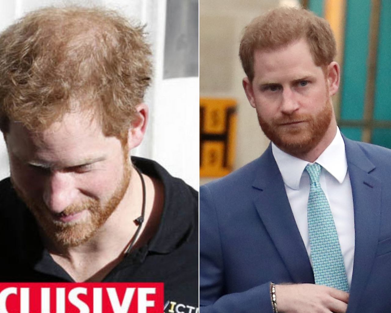 Prince Harry before and after possible hair restoration
