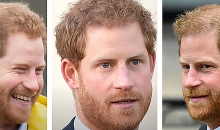 Prince Harry Hair Transplant Featured Image