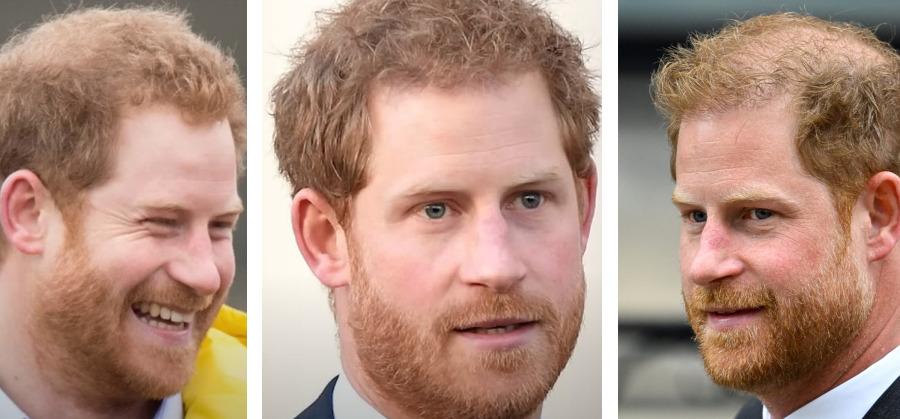 Prince Harry Hair Transplant Featured Image